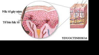 Trị nám da với y học cổ truyền.